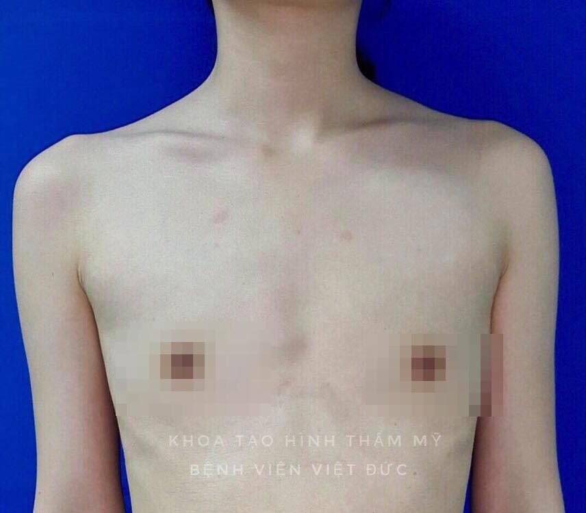 After 2 hours of surgery, a Ha Noi girl with the chest that is “flatter  than men” became full